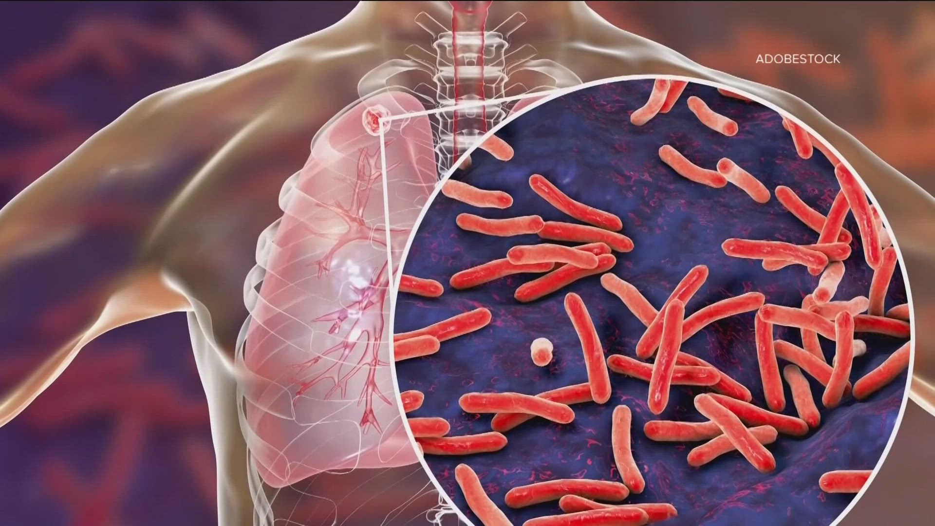 TB is one of the world's leading infectious-disease killers and is spread person-to-person by germs that can stay in the air for hours.