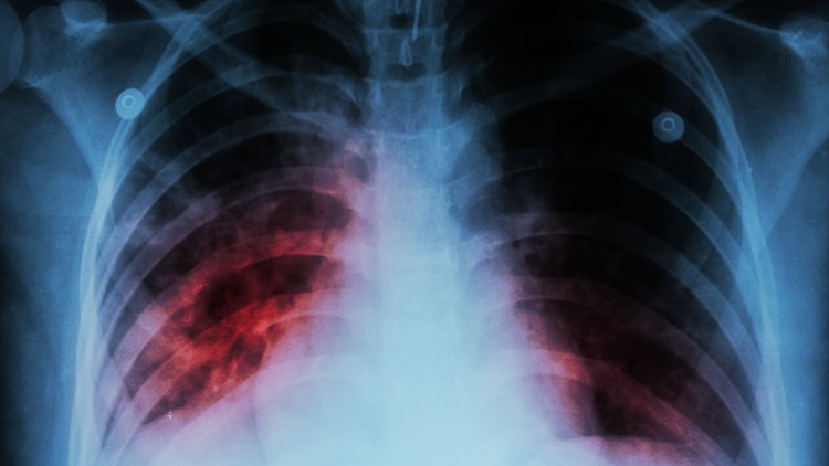 Woman with tuberculosis detained after refusing treatment