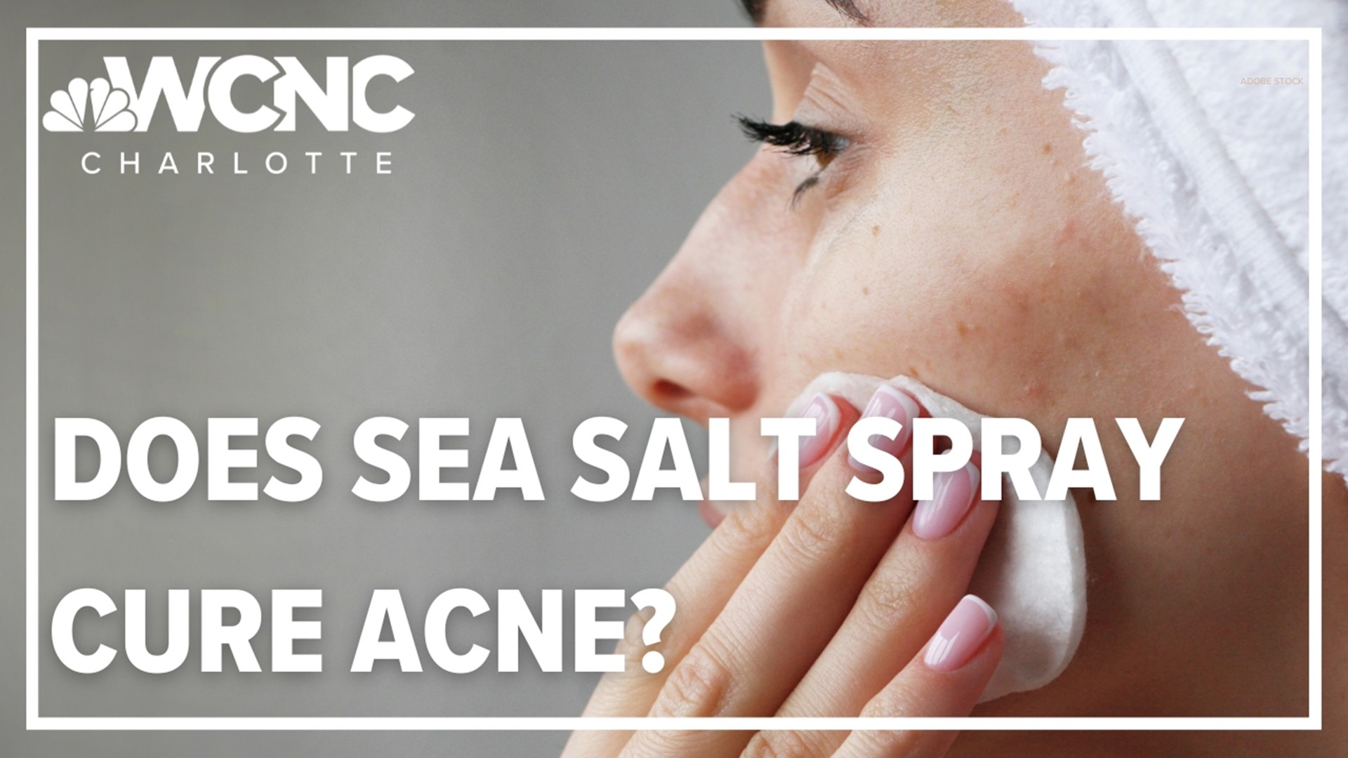 The American Academy of Dermatology Association lists diagnosis and treatment for all types of acne, and sea salt spray is not on that list.