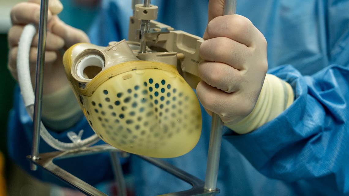 First artificial heart transplant in woman performed in Louisville