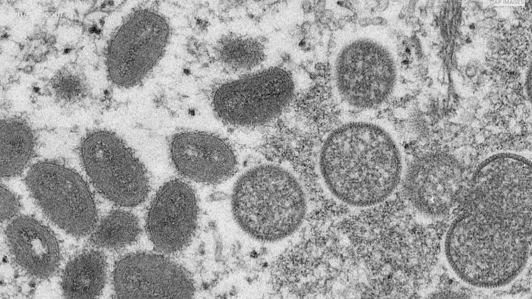 'Concerning but not surprising': Public health officials report first probable case of Monkeypox in Jefferson County