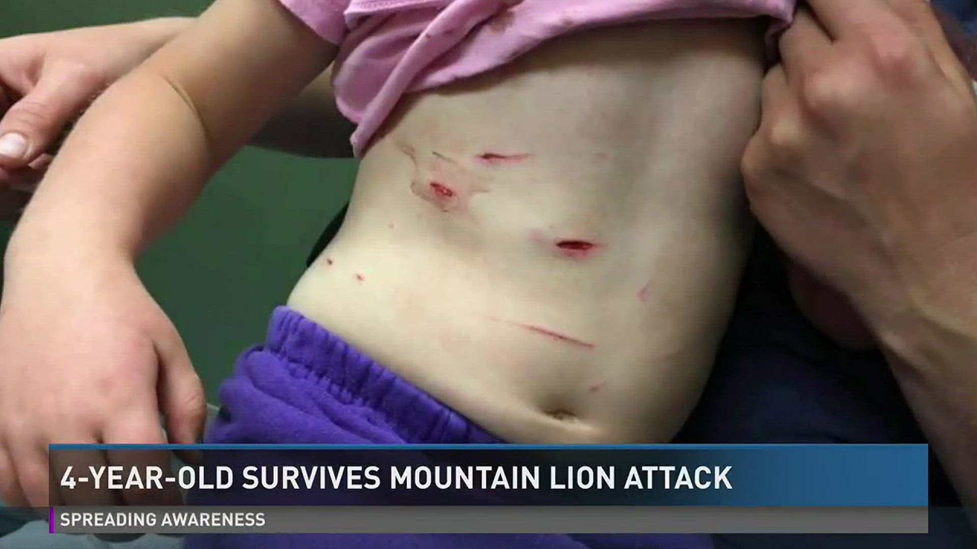 4-year-old survives mountain lion attack