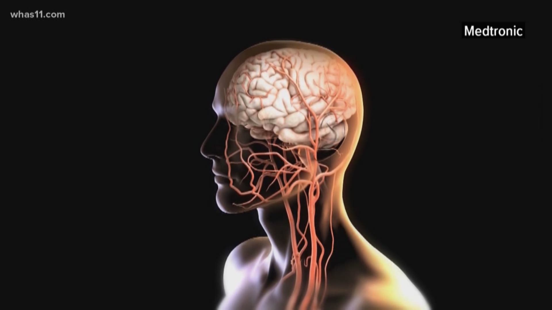 May is Stroke Awareness Month. Today WHAS11's Juliana Valencia talked with Dr. Jignesh Shah, a neurologist with the University of Louisville, about how to detect the signs of a stroke.