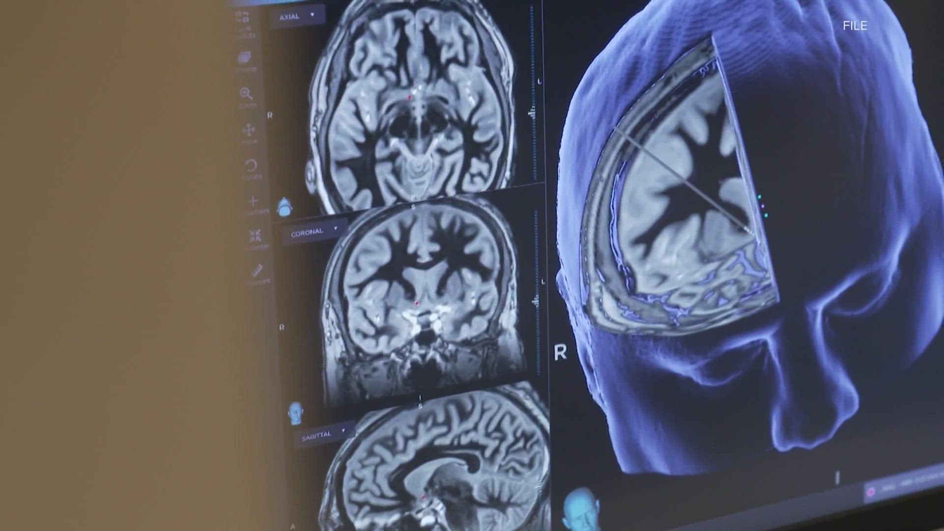 uofl-health-discusses-signs-symptoms-of-stroke-whas11