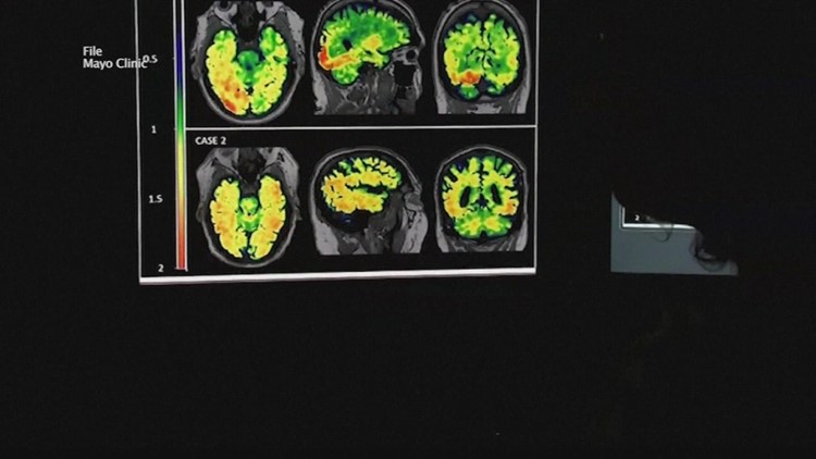 New drug could be Alzheimer's breakthrough