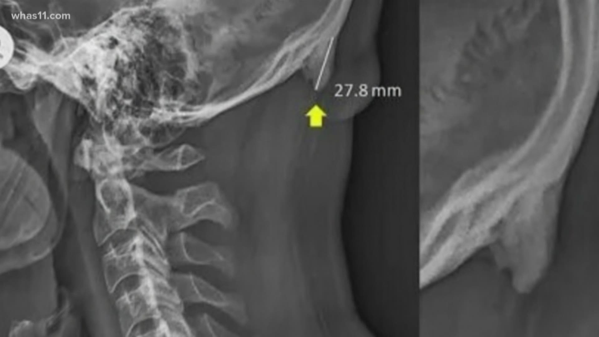 A 2018 study saw bony growths at the base of the skull in younger participants, but are these actually horns from cellphone use?