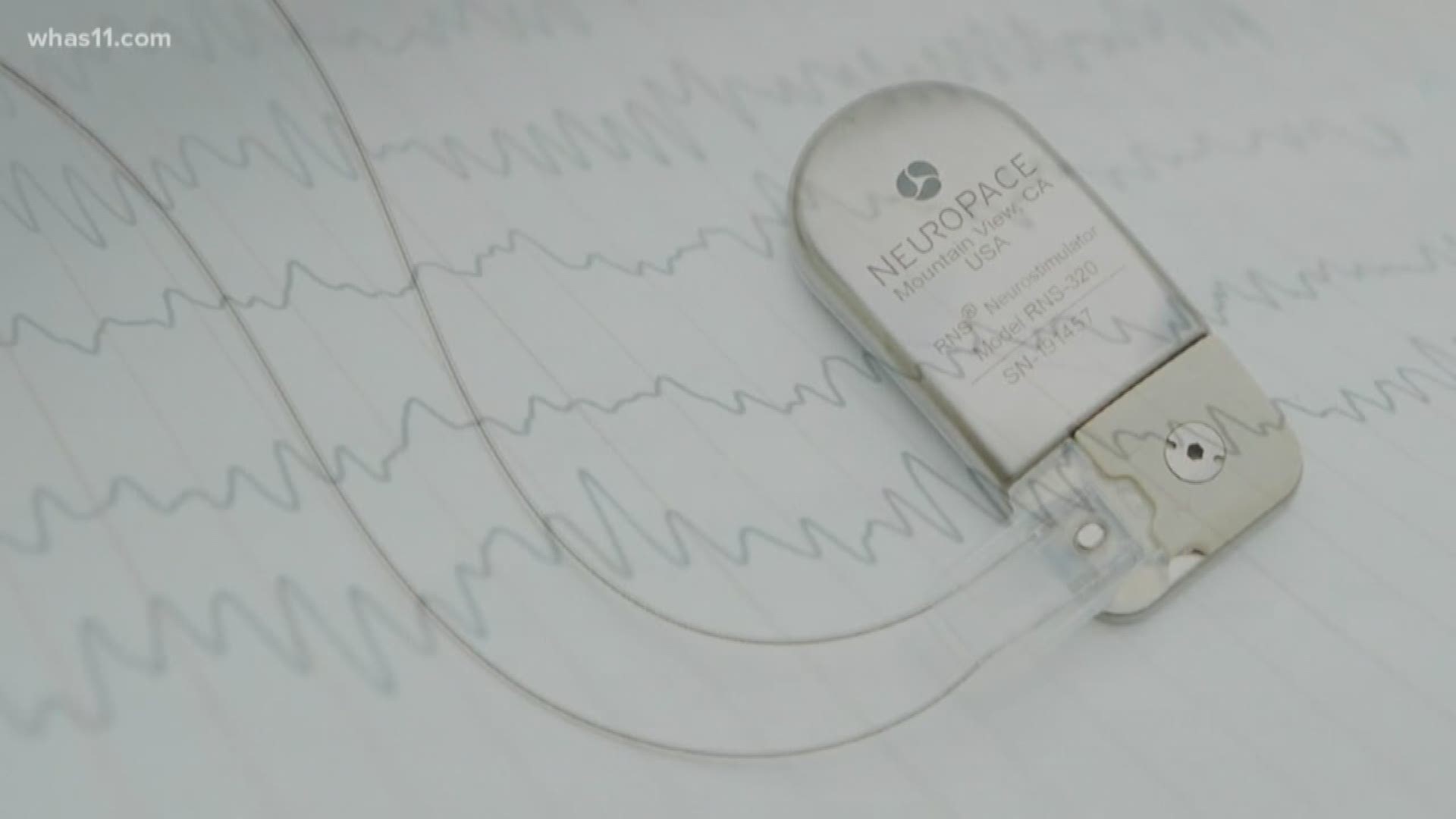 Medicine helps some struggling with epilepsy, but a new device similar to a pacemaker is making waves in the field, cutting down the number of seizures and their side effects.