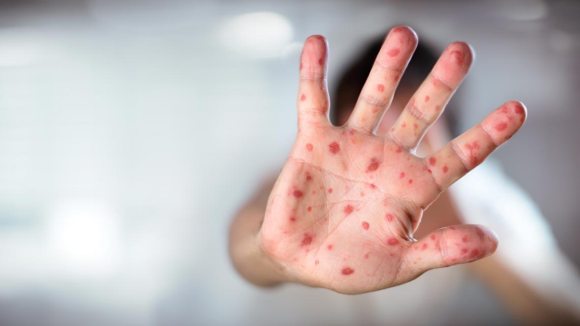 Second confirmed measles case reported in Kentucky child
