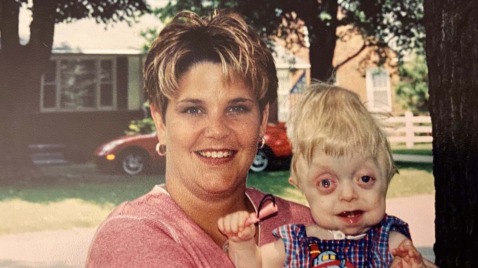 Braden West was never supposed to live past 18 months, let alone 18 years. Braden was diagnosed with Pfeiffer syndrome, a rare cranio-facial condition.