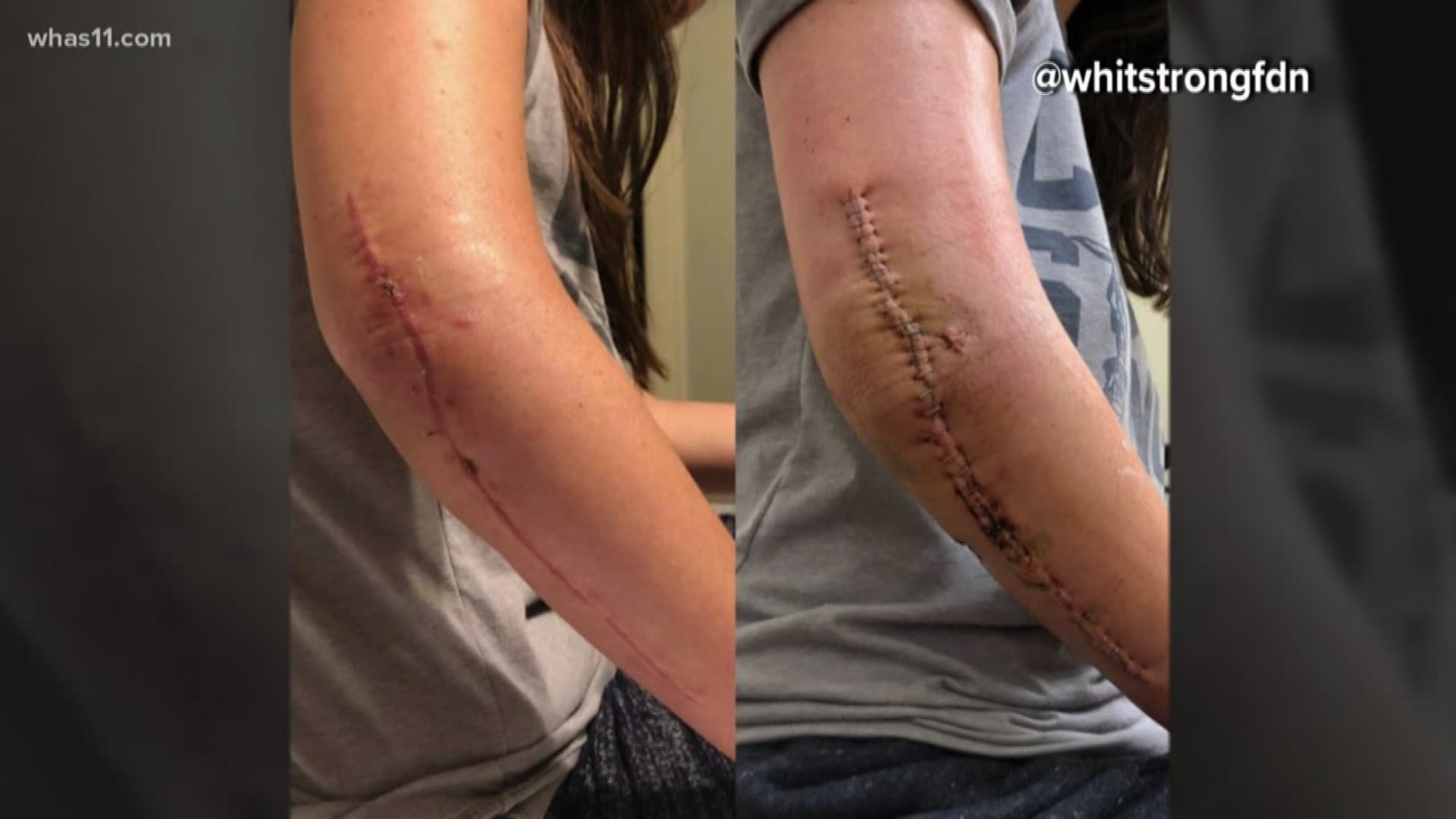 The recent picture shows her arm that sustained major trauma but is healing nicely.