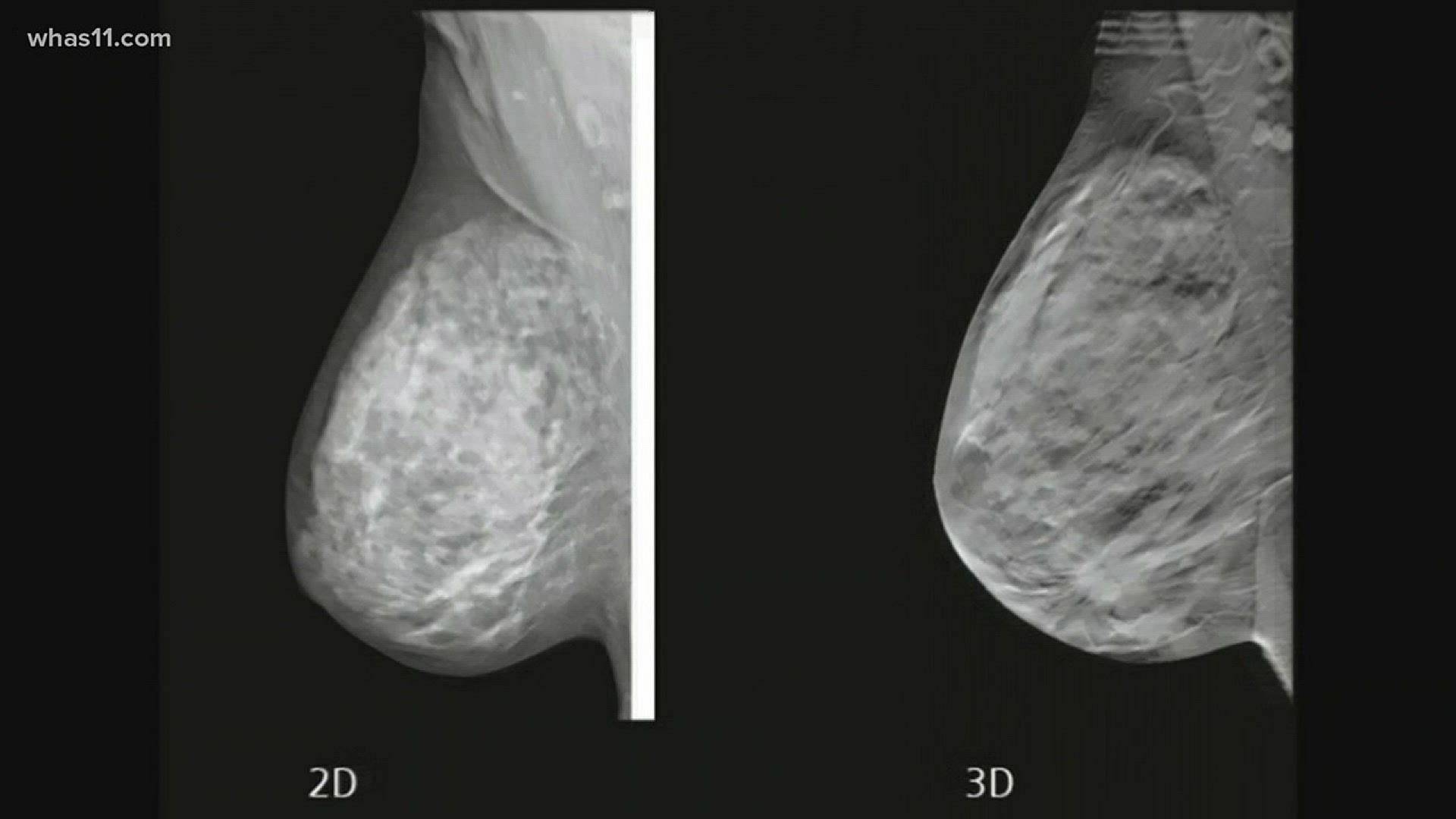 The difference between 2D and 3D mammograms