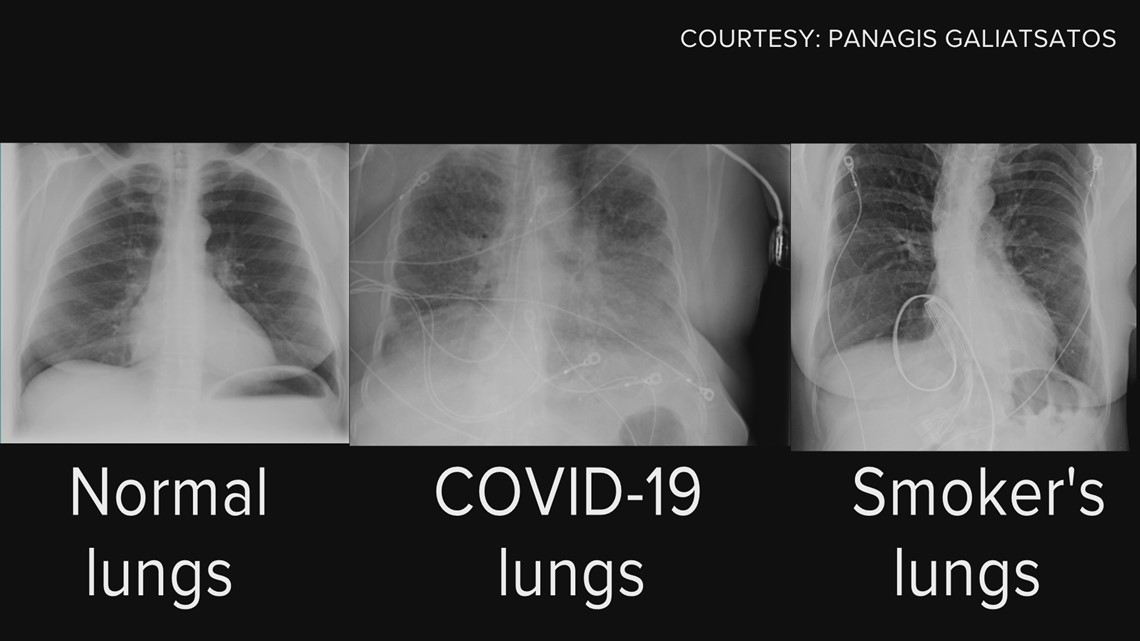 what do lungs sound like with pneumonia